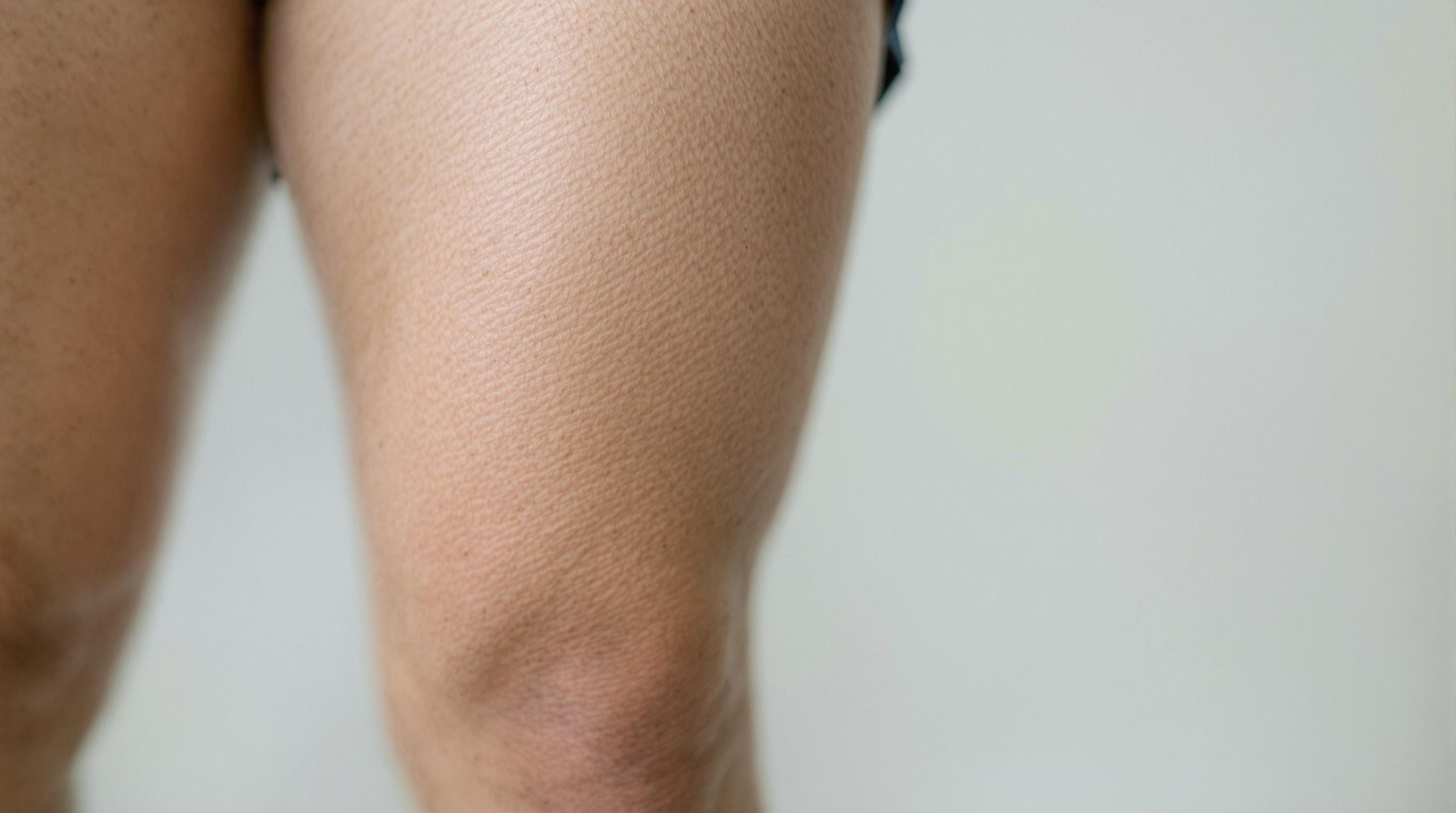 Vergetures sur les cuisses chez les hommes : causes, traitements et prévention - Construisez votre propre style de vie : Astuces pour créer une routine qui vous ressemble